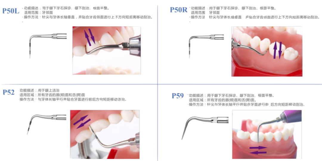 牙周治疗仪怎么做牙周欧乐华牙周治疗仪_https://www.jmylbn.com_新闻资讯_第14张