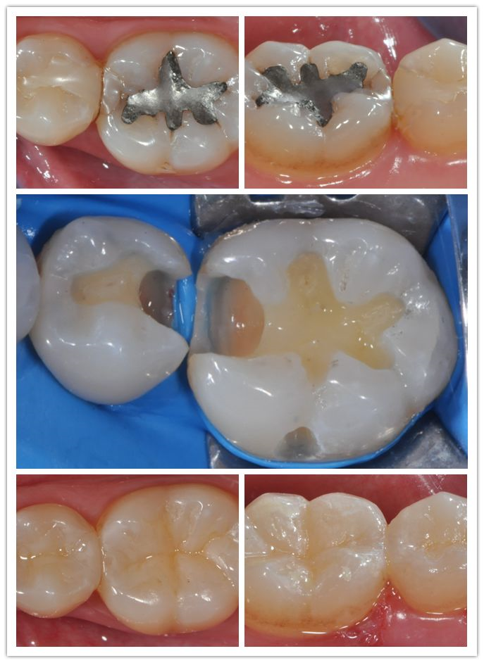 郑州站2021年6月2830日马小寒老师规范化树脂操作升华班树脂美学修复