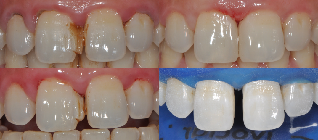 郑州站2021年6月2830日马小寒老师规范化树脂操作升华班树脂美学修复