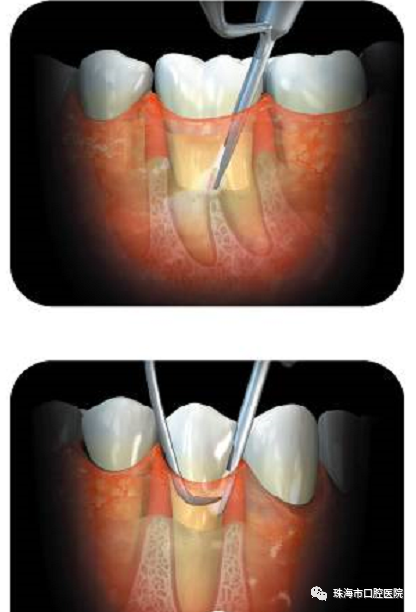 口腔内窥镜怎么用【科普知识】牙周内窥镜——  一种微创的牙周炎治疗设备_https://www.jmylbn.com_新闻资讯_第2张