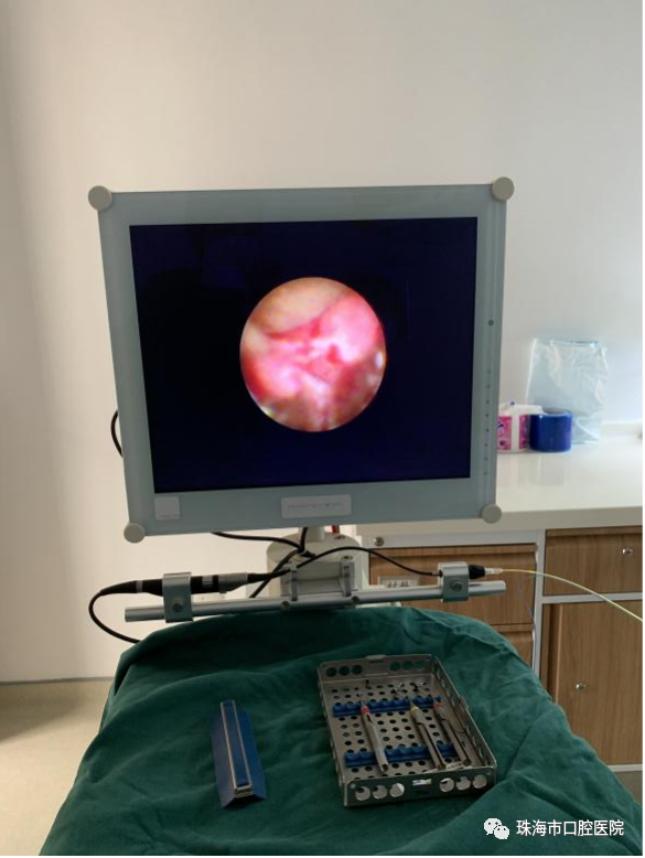 口腔内窥镜怎么用【科普知识】牙周内窥镜——  一种微创的牙周炎治疗设备_https://www.jmylbn.com_新闻资讯_第4张