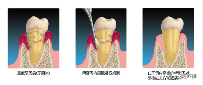 口腔内窥镜怎么用【科普知识】牙周内窥镜——  一种微创的牙周炎治疗设备_https://www.jmylbn.com_新闻资讯_第1张