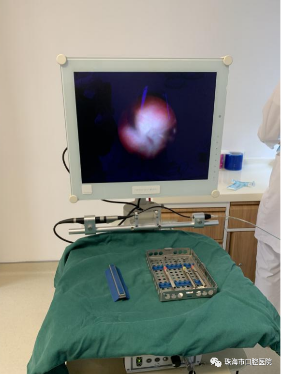 口腔内窥镜怎么用【科普知识】牙周内窥镜——  一种微创的牙周炎治疗设备_https://www.jmylbn.com_新闻资讯_第5张