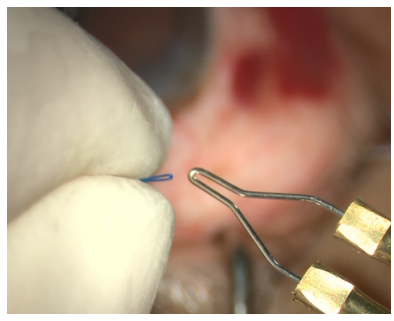 手术拉钩怎么拉手术视频丨植入性囊袋拉钩固定晶状体囊袋的技术要点_https://www.jmylbn.com_新闻资讯_第10张