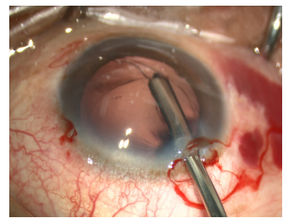 手术拉钩怎么拉手术视频丨植入性囊袋拉钩固定晶状体囊袋的技术要点_https://www.jmylbn.com_新闻资讯_第14张