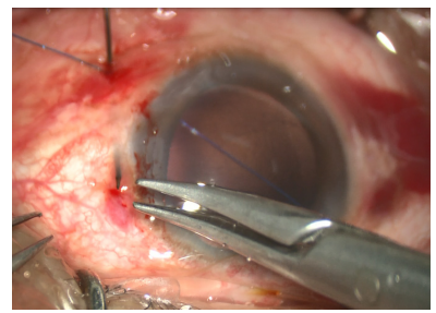 手术拉钩怎么拉手术视频丨植入性囊袋拉钩固定晶状体囊袋的技术要点_https://www.jmylbn.com_新闻资讯_第16张
