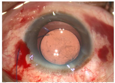 手术拉钩怎么拉手术视频丨植入性囊袋拉钩固定晶状体囊袋的技术要点_https://www.jmylbn.com_新闻资讯_第18张
