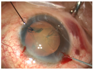 手术拉钩怎么拉手术视频丨植入性囊袋拉钩固定晶状体囊袋的技术要点_https://www.jmylbn.com_新闻资讯_第12张