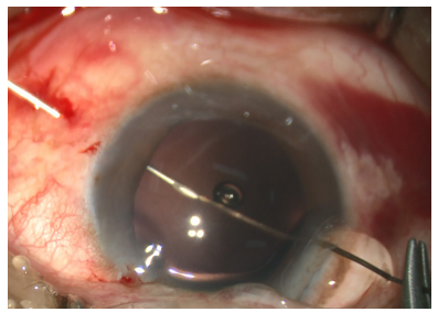 手术拉钩怎么拉手术视频丨植入性囊袋拉钩固定晶状体囊袋的技术要点_https://www.jmylbn.com_新闻资讯_第15张