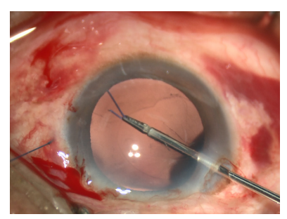 手术拉钩怎么拉手术视频丨植入性囊袋拉钩固定晶状体囊袋的技术要点_https://www.jmylbn.com_新闻资讯_第17张