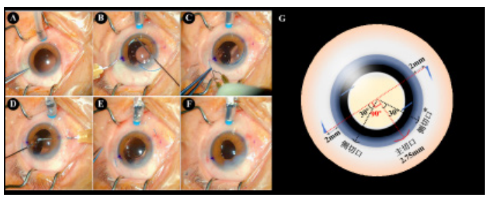 手术膜怎么用手术视频丨YAMANE式后房型人工晶状体巩膜层间固定术的改良与应用_https://www.jmylbn.com_新闻资讯_第8张