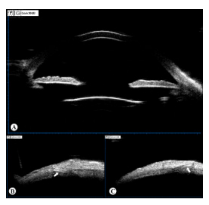 手术膜怎么用手术视频丨YAMANE式后房型人工晶状体巩膜层间固定术的改良与应用_https://www.jmylbn.com_新闻资讯_第5张