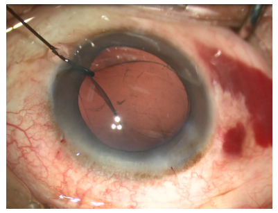 手术拉钩怎么拉手术视频丨植入性囊袋拉钩固定晶状体囊袋的技术要点_https://www.jmylbn.com_新闻资讯_第13张