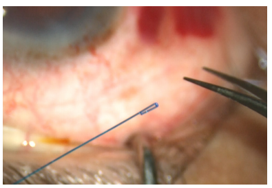 手术拉钩怎么拉手术视频丨植入性囊袋拉钩固定晶状体囊袋的技术要点_https://www.jmylbn.com_新闻资讯_第11张