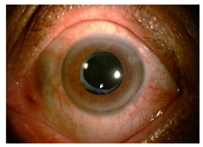 手术拉钩怎么拉手术视频丨植入性囊袋拉钩固定晶状体囊袋的技术要点_https://www.jmylbn.com_新闻资讯_第7张