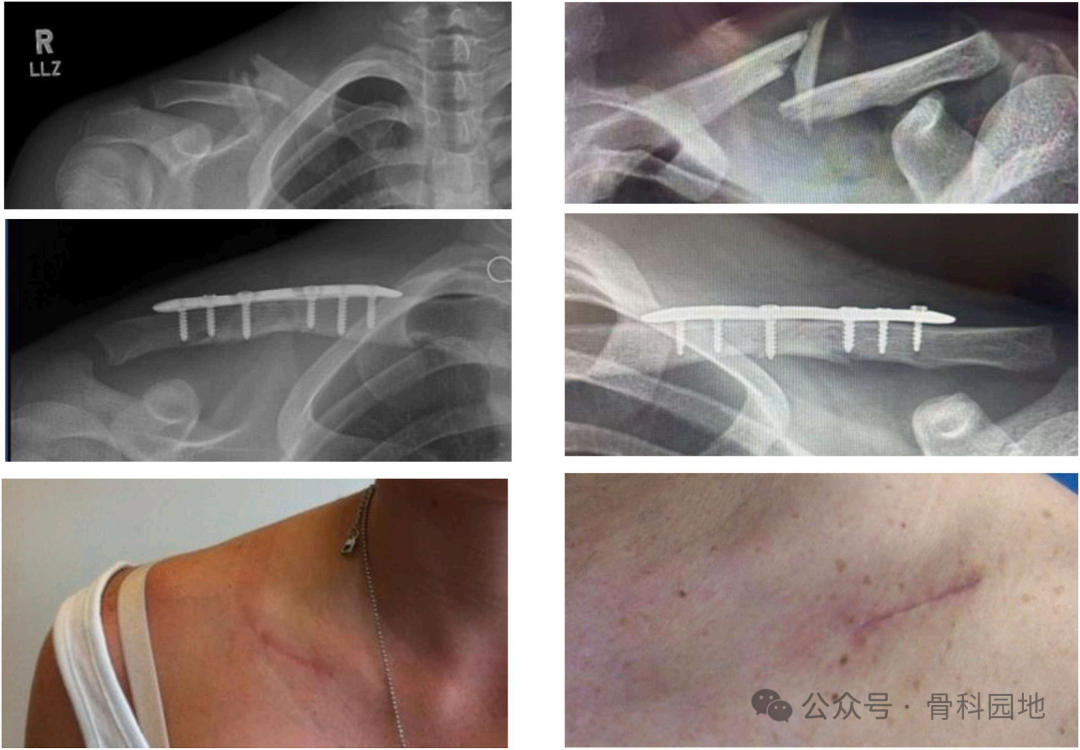 两种锁骨中段粉碎性骨折微创钢板内固定术手术技巧