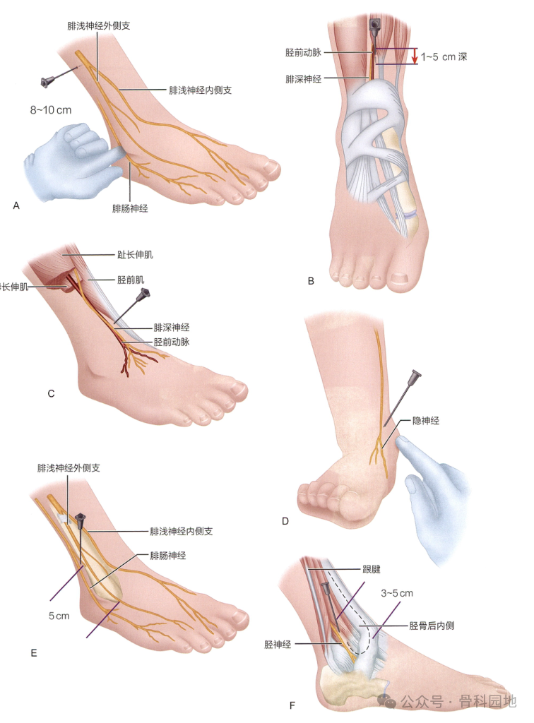 足部手术局麻怎么打，详解踝关节、足部神经阻滞