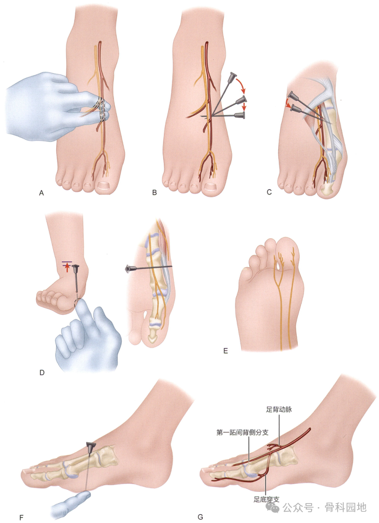 足部手术局麻怎么打，详解踝关节、足部神经阻滞