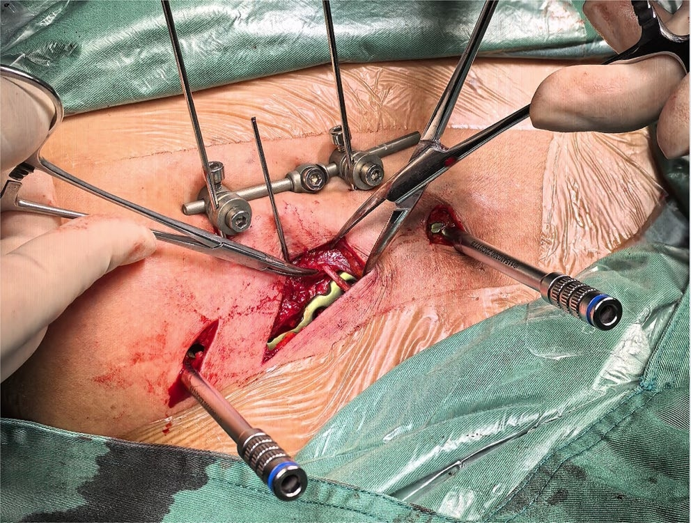 两种锁骨中段粉碎性骨折微创钢板内固定术手术技巧