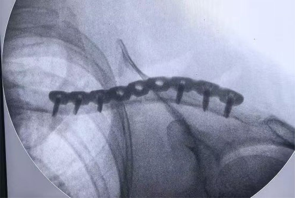 两种锁骨中段粉碎性骨折微创钢板内固定术手术技巧