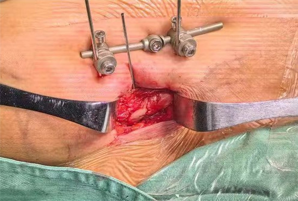 两种锁骨中段粉碎性骨折微创钢板内固定术手术技巧