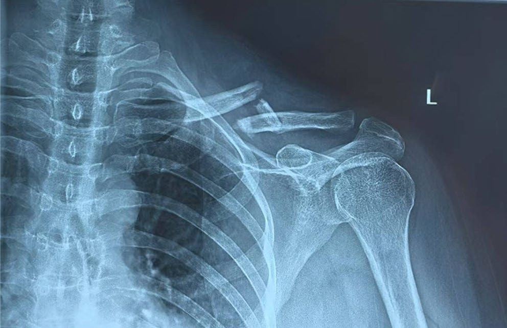 两种锁骨中段粉碎性骨折微创钢板内固定术手术技巧