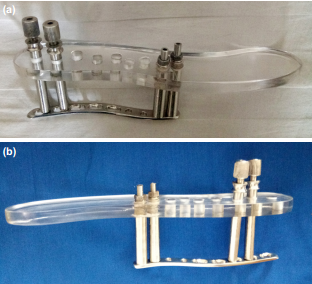 两种锁骨中段粉碎性骨折微创钢板内固定术手术技巧