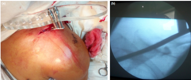 两种锁骨中段粉碎性骨折微创钢板内固定术手术技巧