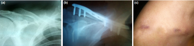 两种锁骨中段粉碎性骨折微创钢板内固定术手术技巧