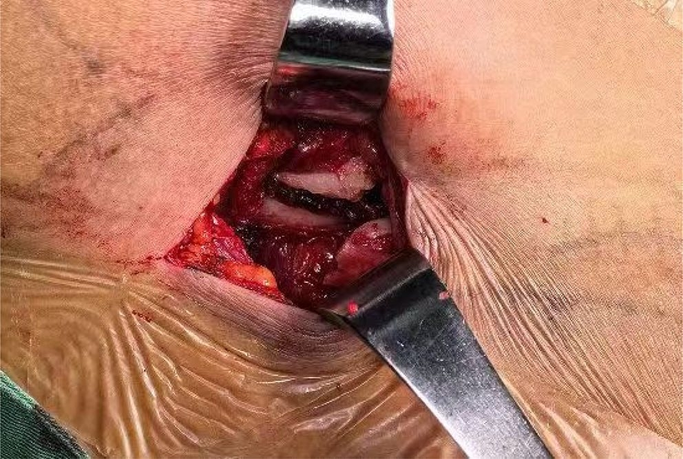 两种锁骨中段粉碎性骨折微创钢板内固定术手术技巧