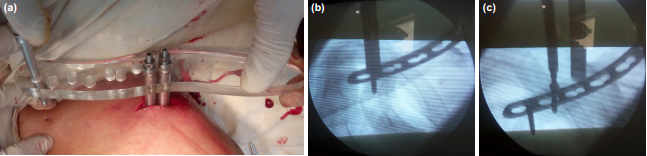 两种锁骨中段粉碎性骨折微创钢板内固定术手术技巧