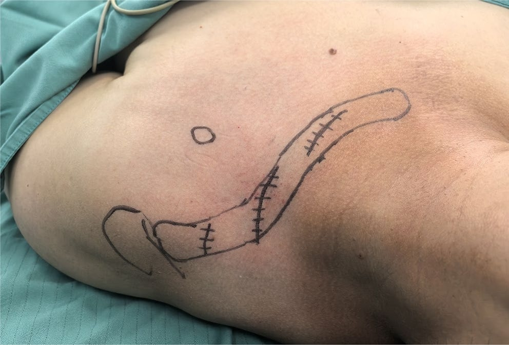 两种锁骨中段粉碎性骨折微创钢板内固定术手术技巧