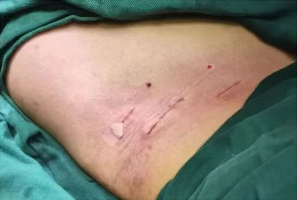 两种锁骨中段粉碎性骨折微创钢板内固定术手术技巧