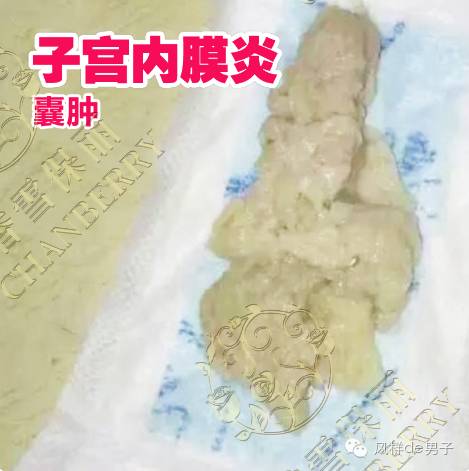 治疗附件炎的方法 1阴道上药 这是正常情况下使用的一种附件炎的治疗