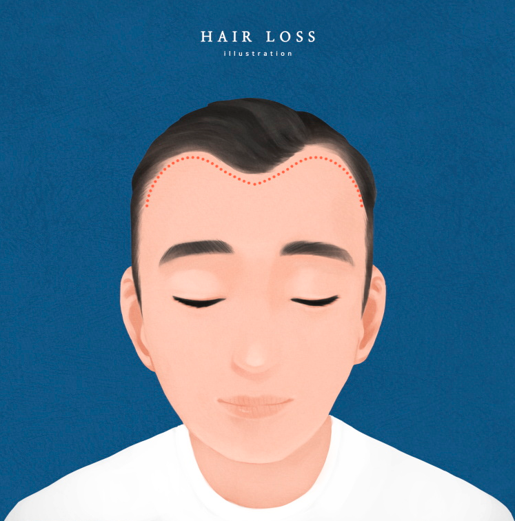 发际线总是往后移？先看多高才正常！