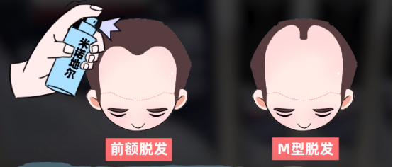 【米诺地尔】这些副作用你真的知道吗？（上篇）