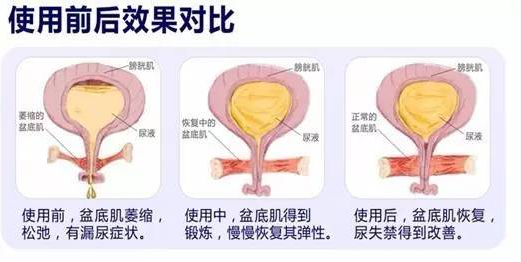 产后康复治疗仪怎么用最新盆底康复治疗仪进驻我院妇产科  解决您的难言之隐_https://www.jmylbn.com_新闻资讯_第8张