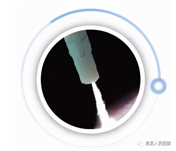 氩气刀是什么内镜下氩离子凝固术（ APC )—消化道疾病患者的福音_https://www.jmylbn.com_新闻资讯_第1张
