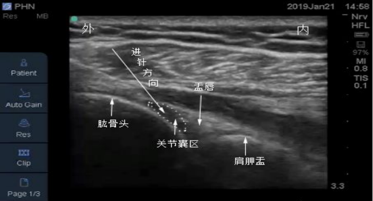 康复仪探头怎么拿【中心动态】快速克服肩周炎，肩关节疾患新克星——超声引导下肩关节穿刺术_https://www.jmylbn.com_新闻资讯_第5张