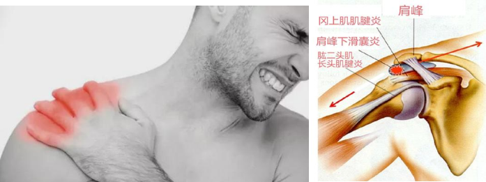 康复仪探头怎么拿【中心动态】快速克服肩周炎，肩关节疾患新克星——超声引导下肩关节穿刺术_https://www.jmylbn.com_新闻资讯_第3张