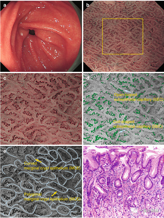 内镜集锦:内镜下正常胃十二指肠黏膜结构_医学界-助力医生临床决策和