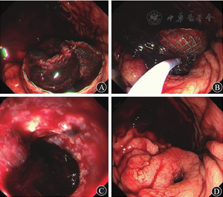 单猪尾支架怎么放重症急性胰腺炎合并出血性休克和感染性休克_https://www.jmylbn.com_新闻资讯_第5张