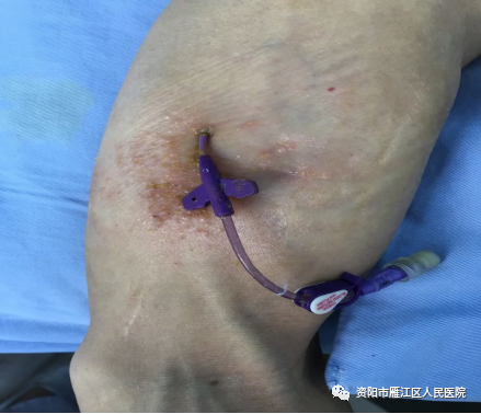 picc导管是什么材质【健康科普】太实用了！PICC导管常见并发症预防及处理，值得珍藏_https://www.jmylbn.com_新闻资讯_第7张