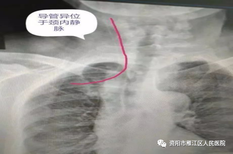 picc导管是什么材质【健康科普】太实用了！PICC导管常见并发症预防及处理，值得珍藏_https://www.jmylbn.com_新闻资讯_第8张