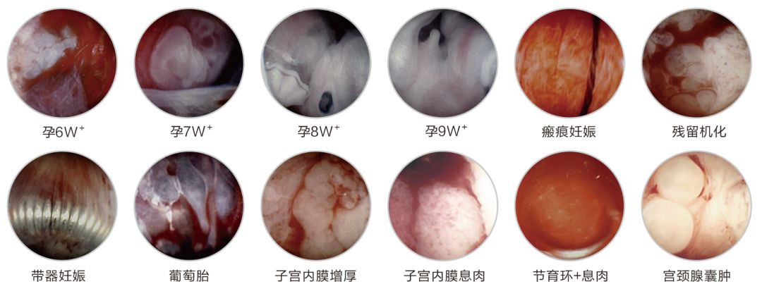 人流吸引管怎么选择爱康医院人流手术‖全程呵护子宫，全面护理，让你恢复如初_https://www.jmylbn.com_新闻资讯_第9张