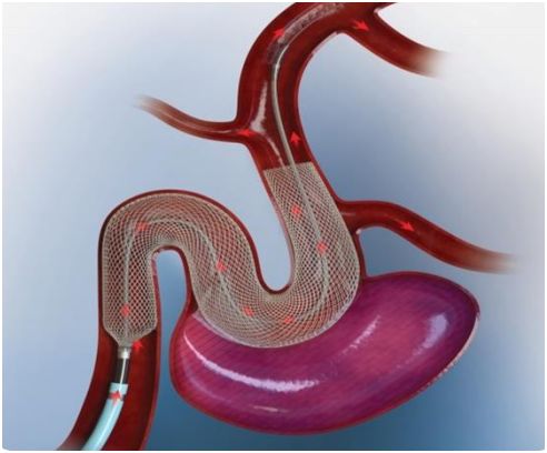 FDA又批準(zhǔn)一款治療動脈瘤的支架
