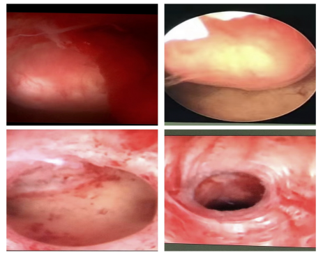 为什么手术用电刀宫腔镜手术冷刀还是电刀，怎么选？_https://www.jmylbn.com_新闻资讯_第1张