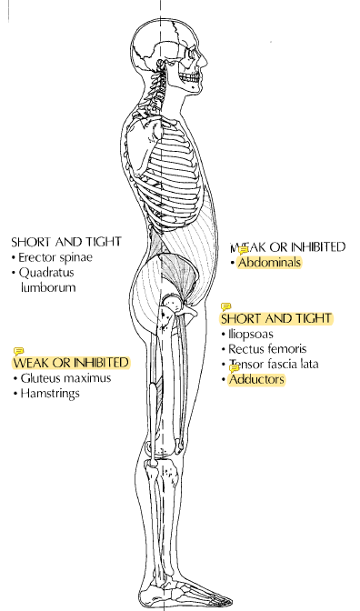 肌肉 肌肉 治疗师眼中的脊椎过度前凸 Hyperlordosis 枫叶之国话康复 微信公众号文章阅读 Wemp