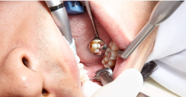 什么是牙科手机当代牙科手机的发展与中国牙科手机品牌崛起_https://www.jmylbn.com_新闻资讯_第4张