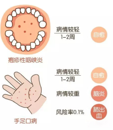 疱疹性咽峡炎是手足口病的小兄弟,主要以发热,口腔黏膜 和咽峡部疱疹